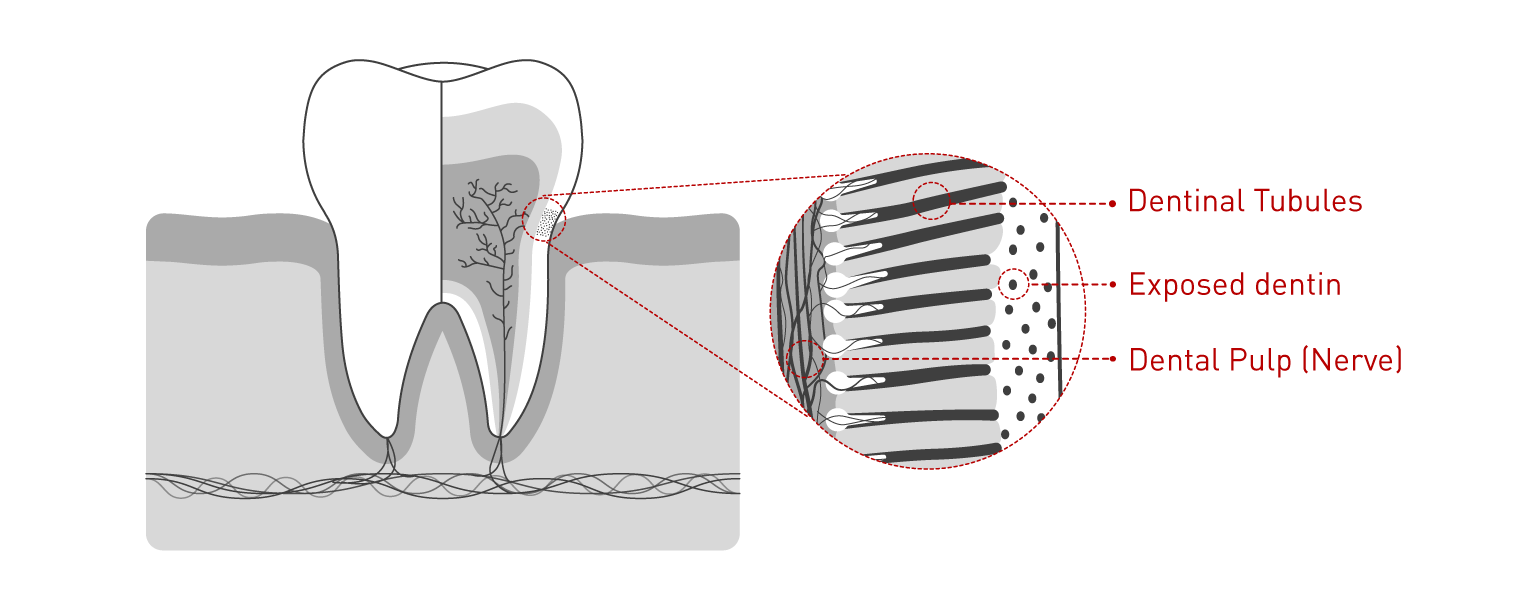 Hipersensibilidad dental 01